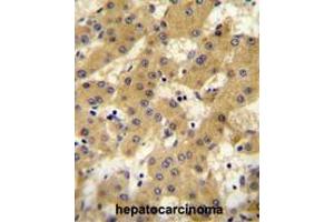 APOF antibody (Center) immunohistochemistry analysis in formalin fixed and paraffin embedded human hepatocarcinoma followed by peroxidase conjugation of the secondary antibody and DAB staining.