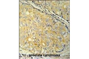 SDHAF1 Antibody (Center) (ABIN651585 and ABIN2840312) immunohistochemistry analysis in formalin fixed and paraffin embedded human prostate carcinoma followed by peroxidase conjugation of the secondary antibody and DAB staining. (SDHAF1 Antikörper  (AA 34-62))