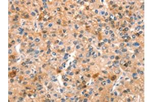 The image on the left is immunohistochemistry of paraffin-embedded Human liver cancer tissue using ABIN7192636(SPRN Antibody) at dilution 1/15, on the right is treated with synthetic peptide.