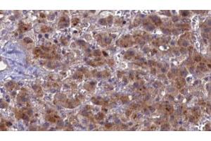 ABIN6276852 at 1/100 staining Human liver cancer tissue by IHC-P. (PTH1R Antikörper  (pThr1))