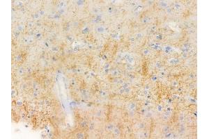 ABIN6255911 and ABIN6267257 at 1/100 staining human glioblastoma by IHC-P.