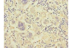 Immunohistochemistry of paraffin-embedded human liver cancer using ABIN7156498 at dilution of 1:100 (Integrin beta 7 Antikörper  (AA 1-140))