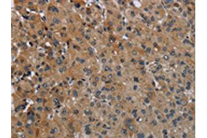The image on the left is immunohistochemistry of paraffin-embedded Human liver cancer tissue using ABIN7129423(FAAH Antibody) at dilution 1/50, on the right is treated with fusion protein.