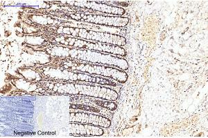 Immunohistochemical analysis of paraffin-embedded human colon cancer tissue. (EIF4A1 Antikörper)