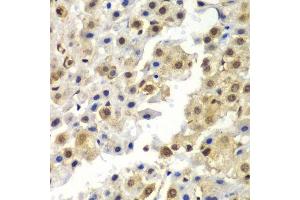 Immunohistochemistry of paraffin-embedded human liver cancer using SYNCRIP antibody. (SYNCRIP Antikörper  (AA 1-200))