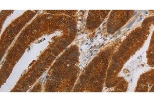 Immunohistochemistry of paraffin-embedded Human colon cancer using NIT2 Polyclonal Antibody at dilution of 1:40 (NIT2 Antikörper)