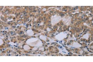 Immunohistochemistry of paraffin-embedded Human thyroid cancer tissue using NAIP Polyclonal Antibody at dilution 1:30 (NAIP Antikörper)