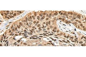 Immunohistochemistry of paraffin-embedded Human esophagus cancer tissue using CCDC112 Polyclonal Antibody at dilution of 1:45(x200) (CCDC112 Antikörper)