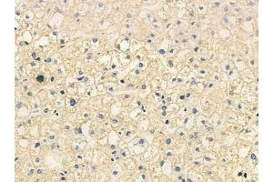 ABIN6258996 and ABIN6276094 at 1/100 staining human hepatocellular carcinoma by IHC-P.