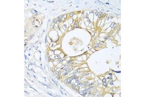 Immunohistochemistry of paraffin-embedded human colon carcinoma using GNAI3 antibody at dilution of 1:100 (40x lens). (GNAI3 Antikörper)