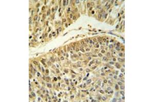 Formalin fixed paraffin embedded lung carcinoma stained with RERE Antibody (N-term) followed by peroxidase conjugation of the secondary antibody and DAB staining. (RERE Antikörper  (N-Term))