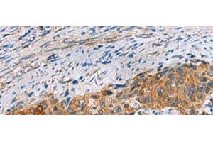 Immunohistochemistry of paraffin-embedded Human cervical cancer tissue using JOSD1 Polyclonal Antibody at dilution of 1:70(x200) (JOSD1 Antikörper)