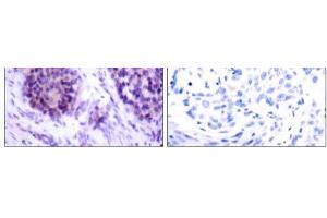 Immunohistochemical analysis of paraffin-embedded human breast carcinoma tissue using BCL-XL (phospho-Ser62) antibody (E011066). (BCL2L1 Antikörper  (pSer62))