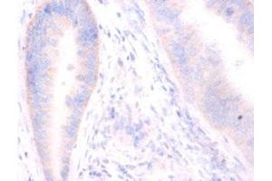 Immunohistochemistry of paraffin-embedded human colon cancer using ABIN7171243 at dilution of 1:100 (Syntaxin 6 Antikörper  (AA 5-234))