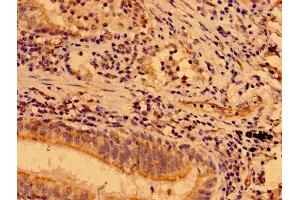 IHC image of ABIN7160061 diluted at 1:400 and staining in paraffin-embedded human lung cancer performed on a Leica BondTM system. (MAP3K9 Antikörper  (AA 864-1098))