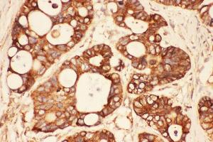 Anti-Src Picoband antibody,  IHC(P): Human Intestinal Cancer Tissue