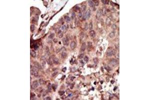 Formalin-fixed and paraffin-embedded human cancer tissue reacted with the primary antibody, which was peroxidase-conjugated to the secondary antibody, followed by AEC staining. (PKLR Antikörper  (C-Term))