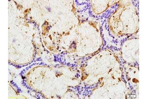 Formalin-fixed and paraffin embedded human colon carcinoma labeled with Anti-CEA(B5) Monoclonal Antibody, Unconjugated (bsm-1624M) at 1:200 followed by conjugation to the secondary antibody and DAB staining (CEA Antikörper)