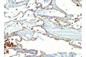 FFPE human lung carcinoma tested with MFG-E8 antibody (SPM291) (MFGE8 Antikörper)