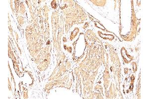 Formalin-fixed, paraffin-embedded human Leiomyosarcoma stained with Smooth Muscle Actin Mouse Monoclonal Antibody (1A4). (Smooth Muscle Actin Antikörper  (N-Term))