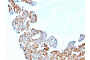 Formalin-fixed, paraffin-embedded human Breast Carcinoma stained with CDC34 Mouse Monoclonal Antibody (CPTC-CDC34-2). (CDC34 Antikörper)