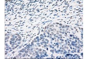 Immunohistochemical staining of paraffin-embedded Adenocarcinoma of colon tissue using anti-PPP5Cmouse monoclonal antibody. (PP5 Antikörper)