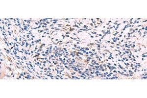 Immunohistochemistry of paraffin-embedded Human cervical cancer tissue using GKAP1 Polyclonal Antibody at dilution of 1:95(x200) (GKAP1 Antikörper)
