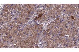 ABIN6277856 at 1/100 staining Human liver cancer tissue by IHC-P. (MAG Antikörper  (C-Term))
