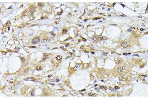 Immunohistochemistry of paraffin-embedded Human liver cancer using PSMA7 Polyclonal Antibody at dilution of 1:100 (40x lens). (PSMA7 Antikörper)
