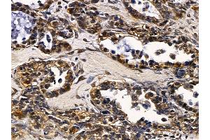 ABIN6257506 and ABIN6274319 at 1/100 staining human ovarian cancer by IHC-P. (SRY Antikörper  (Internal Region))
