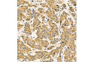 Immunohistochemistry of paraffin embedded human colon cancer using BPTF (ABIN7073234) at dilution of 1:500 (400x lens) (BPTF Antikörper)