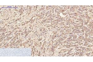 Immunohistochemistry of paraffin-embedded Human breast cancer tissue using AFP Monoclonal Antibody at dilution of 1:200. (alpha Fetoprotein Antikörper)