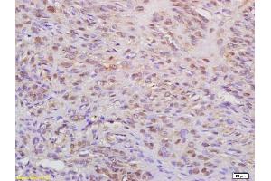 Formalin-fixed and paraffin embedded human cervical carcinoma labeled with Anti-WAPL Polyclonal Antibody, Unconjugated (ABIN872457) at 1:200 followed by conjugation to the secondary antibody (WAPAL Antikörper  (AA 731-830))