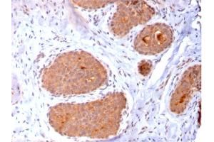Formalin-fixed, paraffin-embedded human Breast Carcinoma stained with HSP60 Mouse Monoclonal Antibody (CPTC-HSPD1-1). (HSPD1 Antikörper)