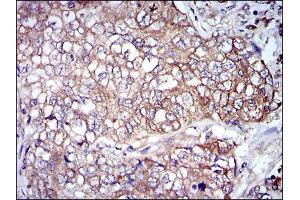 Immunohistochemical analysis of paraffin-embedded lung cancer tissues using NEFL mouse mAb with DAB staining. (NEFL Antikörper)