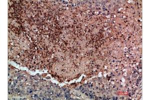 Immunohistochemical analysis of paraffin-embedded human-lung-cancer, antibody was diluted at 1:200 (DDR2 Antikörper  (AA 31-80))