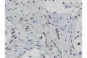 Immunohistochemical staining of paraffin-embedded Carcinoma of Human kidney tissue using anti-NT5DC1 mouse monoclonal antibody. (NT5DC1 Antikörper)