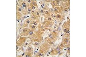 Formalin-fixed and paraffin-embedded human hepatocarcinoma tissue reacted with APOA5 antibody (N-term), which was peroxidase-conjugated to the secondary antibody, followed by DAB staining.