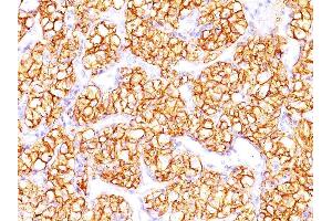 Formalin-fixed, paraffin-embedded human Renal Cell Carcinoma stained with PNA Mouse Monoclonal Antibody (PN-15). (CA9 Antikörper)