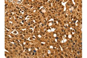 The image on the left is immunohistochemistry of paraffin-embedded Human breast cancer tissue using ABIN7192644(SRGAP1 Antibody) at dilution 1/25, on the right is treated with synthetic peptide. (SRGAP1 Antikörper)