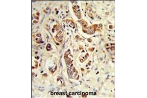 Formalin-fixed and paraffin-embedded human breast carcinoma reacted with NCF1C Antibody (C-term), which was peroxidase-conjugated to the secondary antibody, followed by DAB staining. (NCF1C Antikörper  (C-Term))