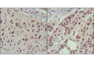 Immunohistochemical analysis of paraffin-embedded human lung cancer (left) and cervical carcinoma (right), showing nuclear localization using ISL1 mouse mAb with DAB staining. (ISL1 Antikörper)