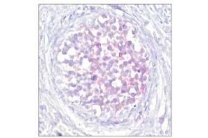 Immunohistochemical analysis of paraffin-embedded human breast carcinoma tissue using Raf-1 (phospho-Ser259) antibody (E011006). (RAF1 Antikörper  (pSer259))