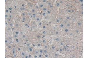 Detection of SPTAN1 in Human Liver cancer Tissue using Polyclonal Antibody to Alpha-Fodrin (SPTAN1) (SPTAN1 Antikörper  (AA 289-408))