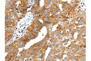 The image on the left is immunohistochemistry of paraffin-embedded Human ovarian cancer tissue using ABIN7192287(SCT Antibody) at dilution 1/40, on the right is treated with synthetic peptide.