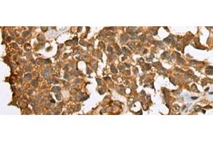 Immunohistochemistry of paraffin-embedded Human ovarian cancer tissue using YBX1 Polyclonal Antibody at dilution of 1:25(x200) (YBX1 Antikörper)