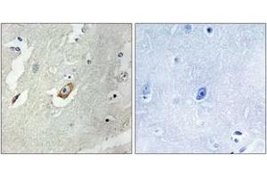 Immunohistochemistry analysis of paraffin-embedded human breast carcinoma tissue, using CDC16/APC6 (Ab-560) Antibody. (CDC16 Antikörper  (AA 526-575))