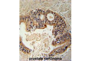 Formalin-fixed and paraffin-embedded human prostate carcinomareacted with DYRK1A polyclonal antibody , which was peroxidase-conjugated to the secondary antibody, followed by AEC staining. (DYRK1A Antikörper  (N-Term))