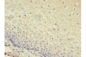 Immunohistochemistry of paraffin-embedded human cervical cancer using ABIN7153613 at dilution of 1:100 (Connexin 31 Antikörper  (AA 211-270))