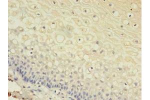 Immunohistochemistry of paraffin-embedded human cervical cancer using ABIN7153613 at dilution of 1:100 (Connexin 31 Antikörper  (AA 211-270))